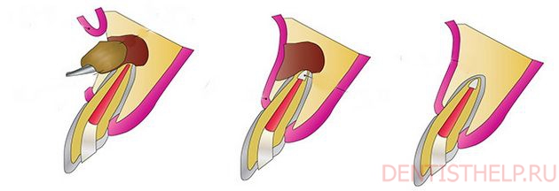 технология проведения резекции корня
