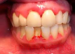 показания к шинированию зубов