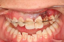 шинирование зубов при переломе зуба