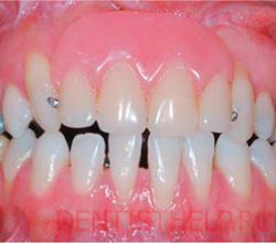 отсутствие одного или нескольких зубов - показания к съемному протезированию