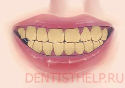 симптомы повреждения зубной эмали