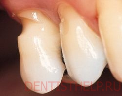 стадии клиновидного дефекта зубов