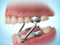 лечение стираемости зубов - коррекция зубов