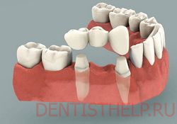 лечение стираемости зубов - восстановление утраченных зубов