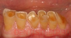 стираемость зубов по распространенности заболевания
