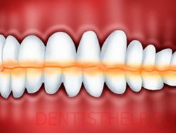 стираемость зубов по степени разрушения