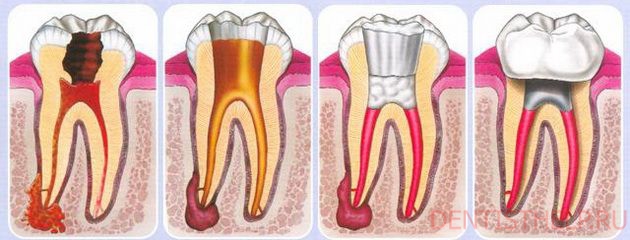 терапевтический метод лечения каналов зуба