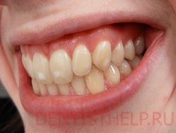 тетрациклиновые зубы симптомы