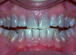 тетрацеклиновые зубы среднее окрашивание