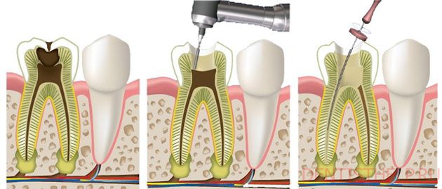 как проводится удаление нерва зуба