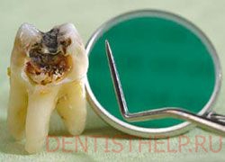 запущенные заболевания зубов - одна из причин их удаления