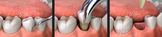 технология удаления зубов