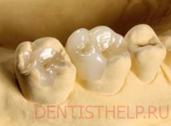 зубные вкладки вместо пломб