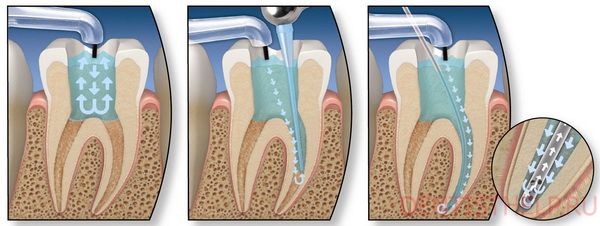технология внутриканального отбеливания зубов