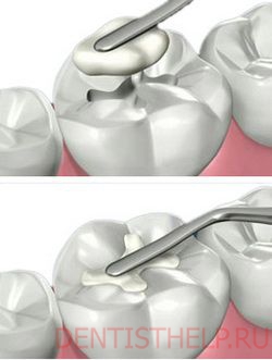 восстановление зубов композитными материалами