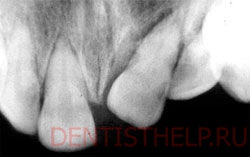 вывих зуба - показания для реплантации зубов