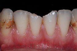 показания к зубным вкладкам