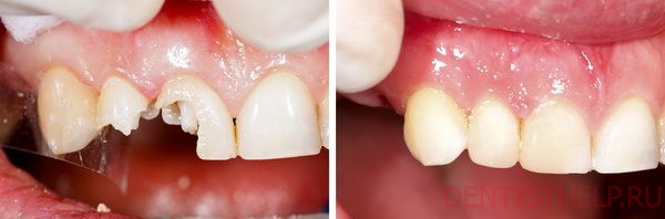 зубные коронки для восстановления отколотых зубов