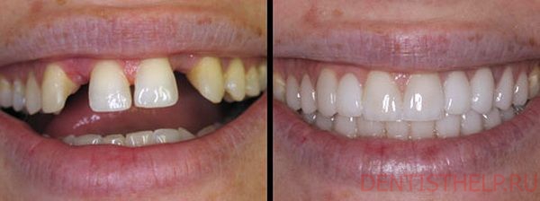 зубные коронки при щелях между зубами