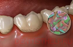 зубной камень, зубные отложения