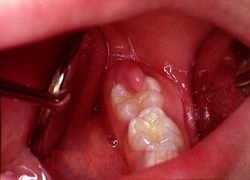 показания для зубосохраняющих операций - перикоронит