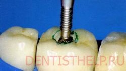 удаление части коронки зуба