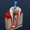 Как происходит лечение корневых каналов