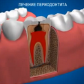 Опасность периодонтита