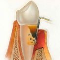 Периодонтит и пародонтит в чем отличия?