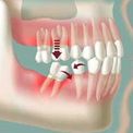 Последствия после удаления зубов