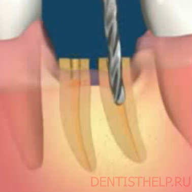 Реставрация полуразрушенного зуба коронками