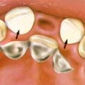 Ретенция зуба
