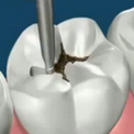 Удаление кариеса и восстановление зубов