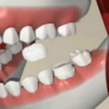 Установка шитифта и депульпация зуба